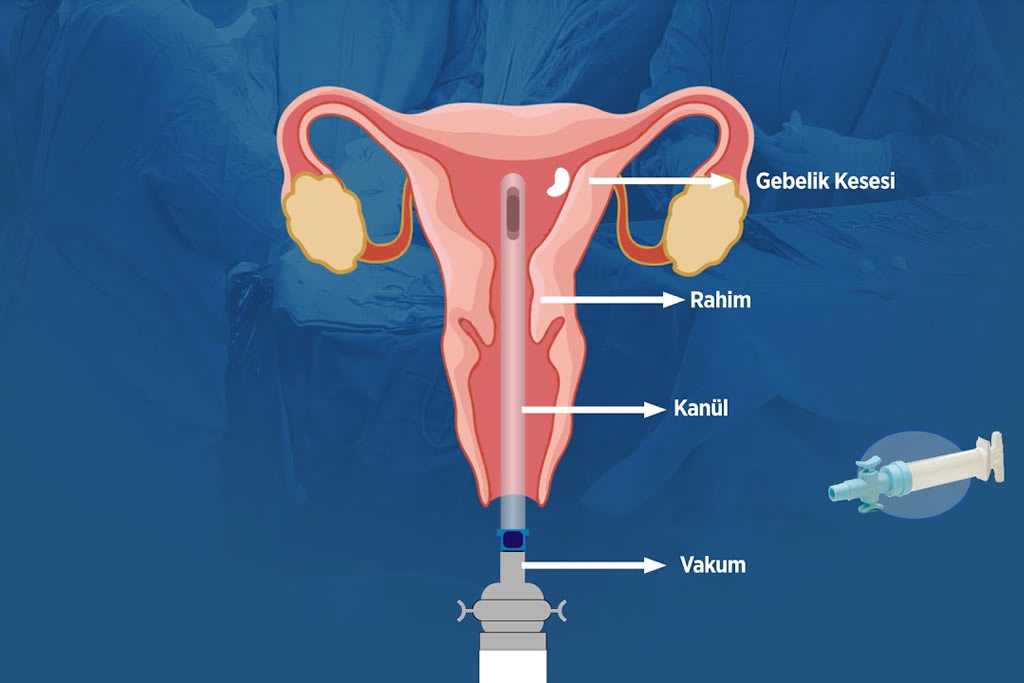 Vakum Yöntemi ile Kürtaj